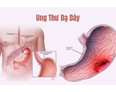 Thuốc đặc trị ung thư dạ dày