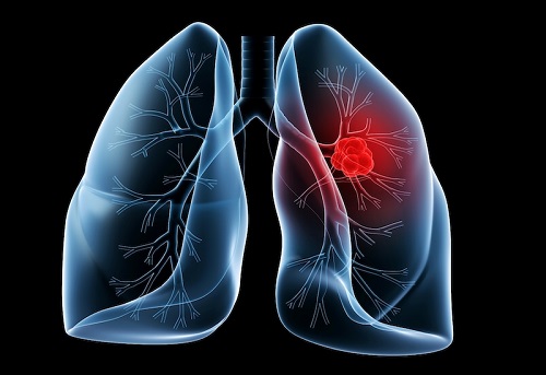 Tỷ lệ sống sót của ung thư phổi không phải tế bào nhỏ giai doạn 1A